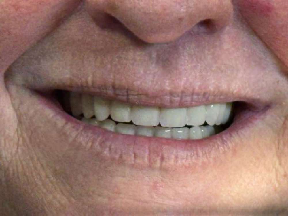 لبخند با اعتماد به نفس بیمار با دندانهای مصنوعی کامل و طبیعی