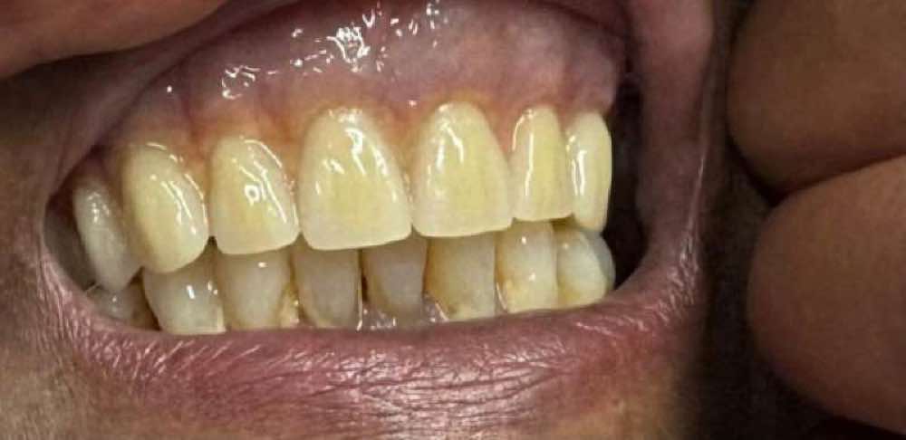 بیمار قبل از دریافت دندان مصنوعی سفارشی با کیفیت بالا