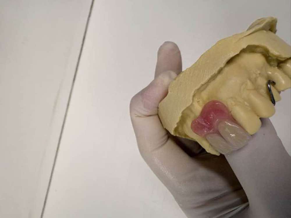 Custom denture samples crafted in Oak Park on-site dental laboratory Melbourne
